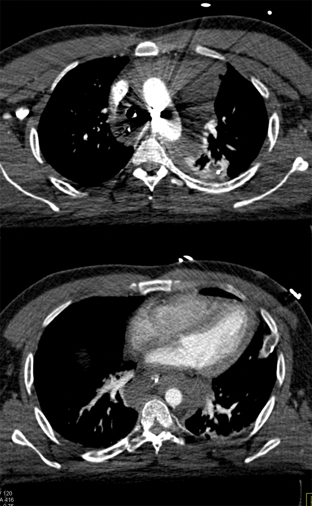 Trauma to the Thoracic Aorta