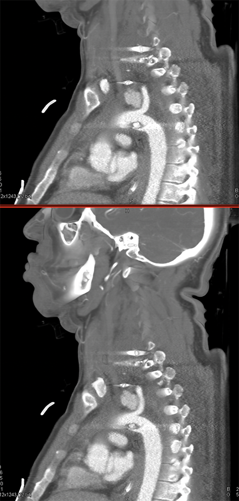 Trauma to the Thoracic Aorta