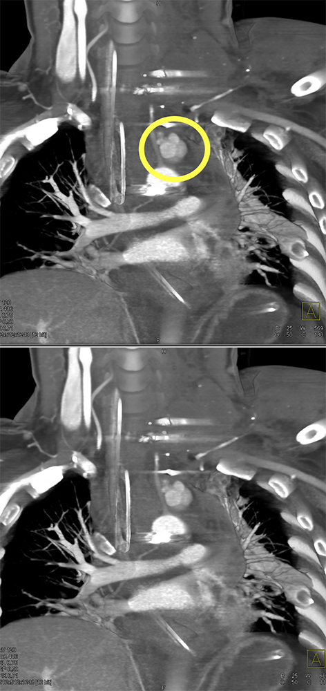 Trauma to the Thoracic Aorta