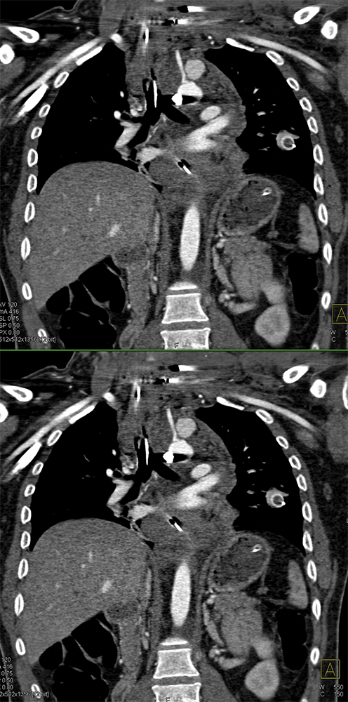 Trauma to the Thoracic Aorta