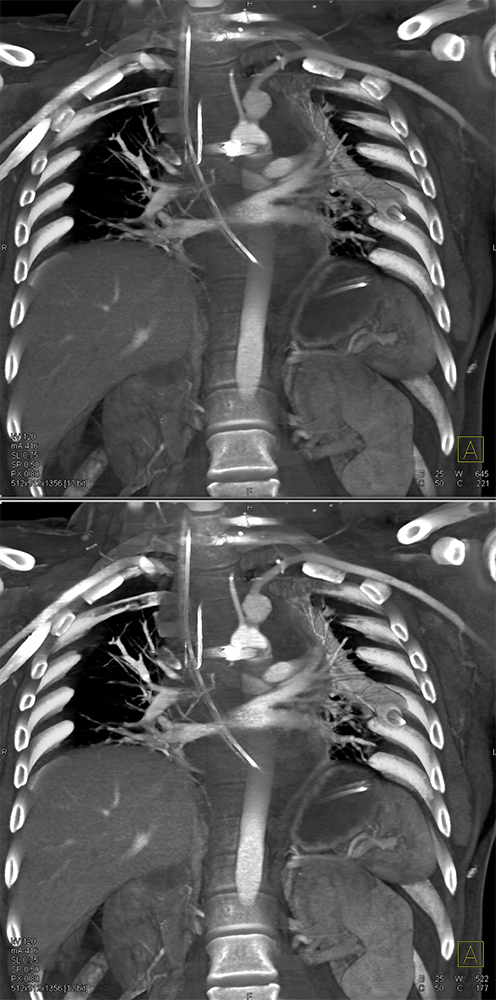 Trauma to the Thoracic Aorta