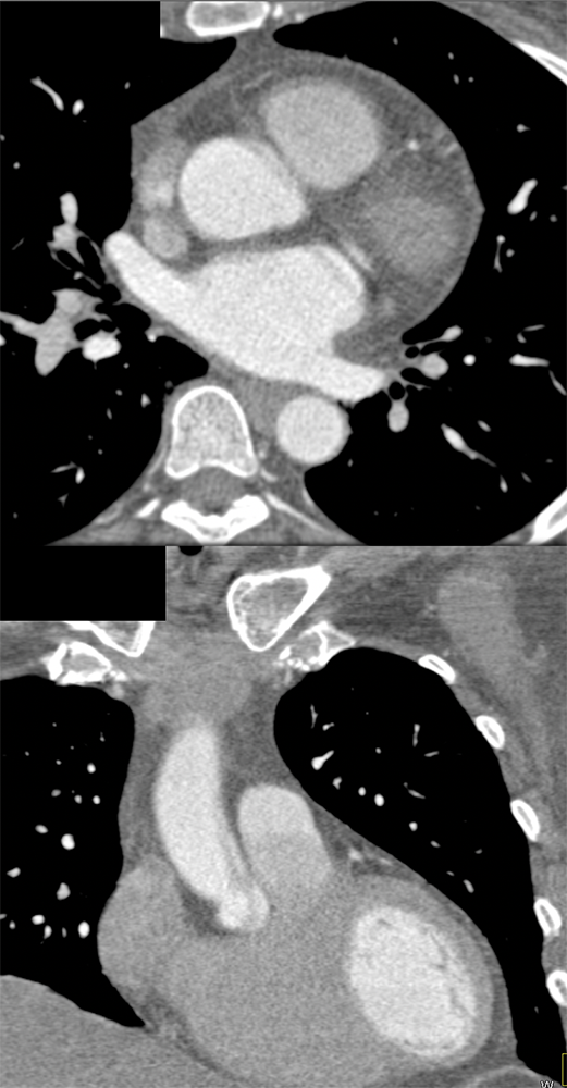 Trauma to the Thoracic Aorta