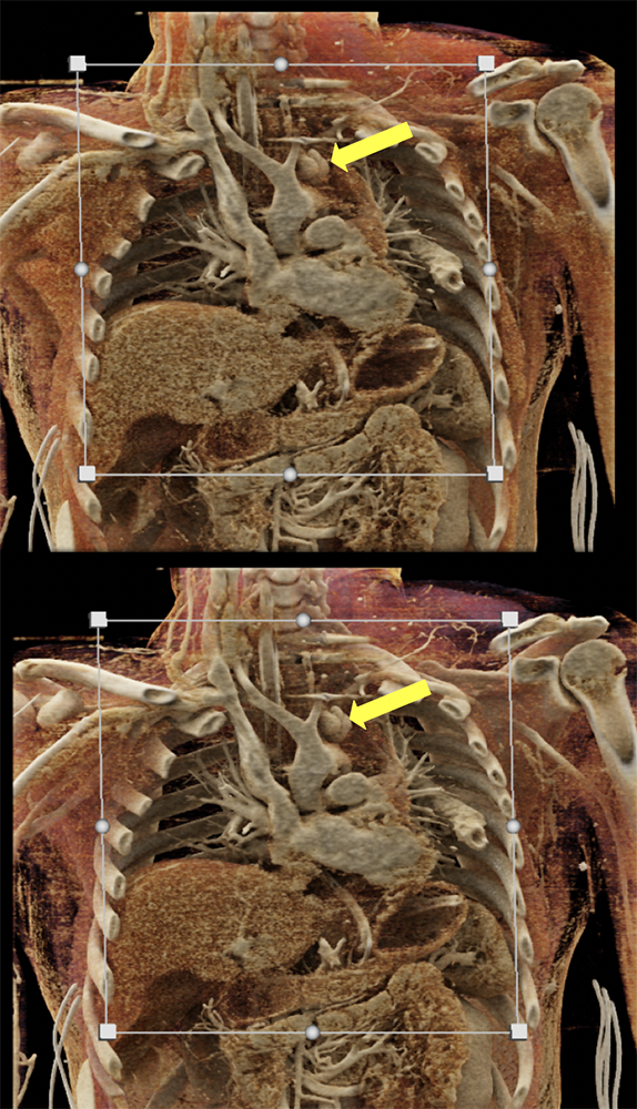 Trauma to the Thoracic Aorta