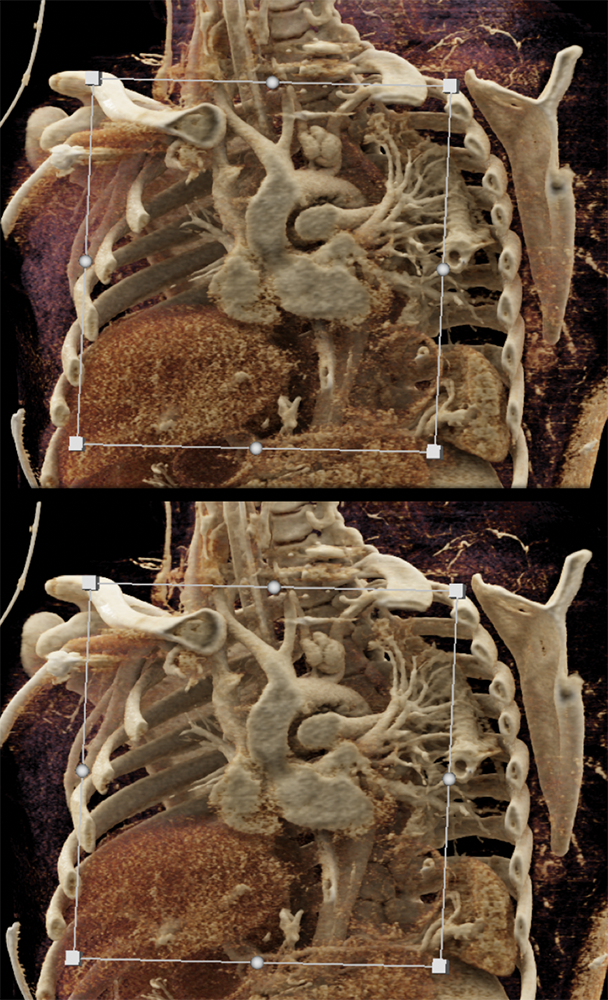 Trauma to the Thoracic Aorta