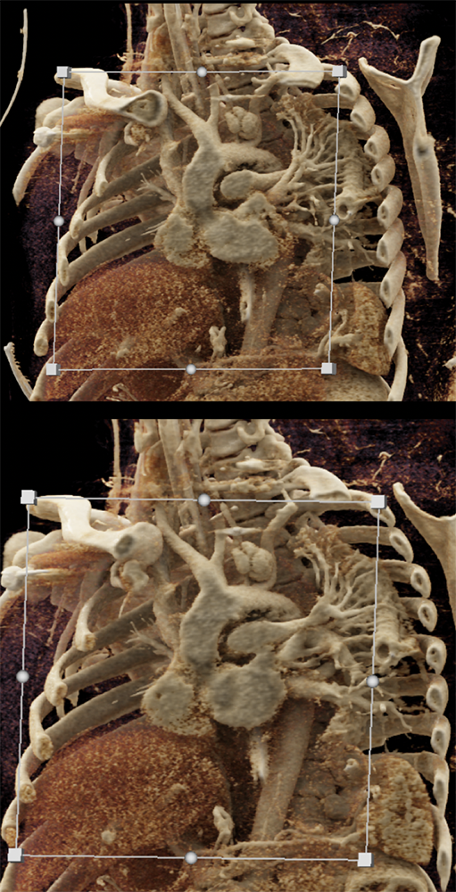 Trauma to the Thoracic Aorta