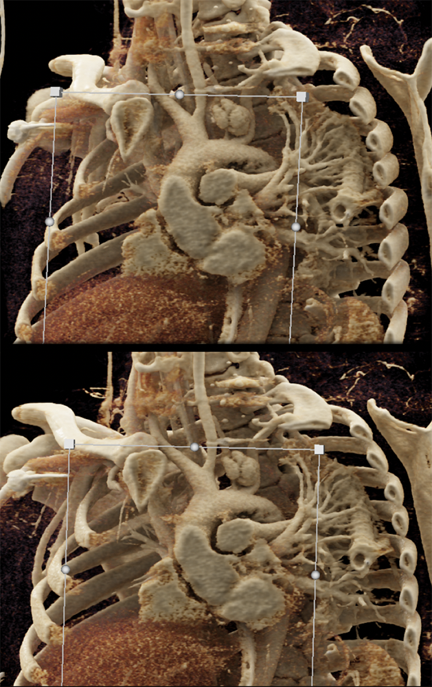 Trauma to the Thoracic Aorta