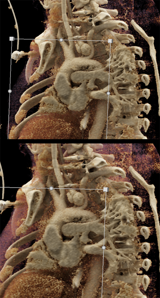 Trauma to the Thoracic Aorta