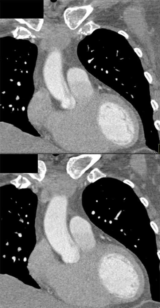 Trauma to the Thoracic Aorta