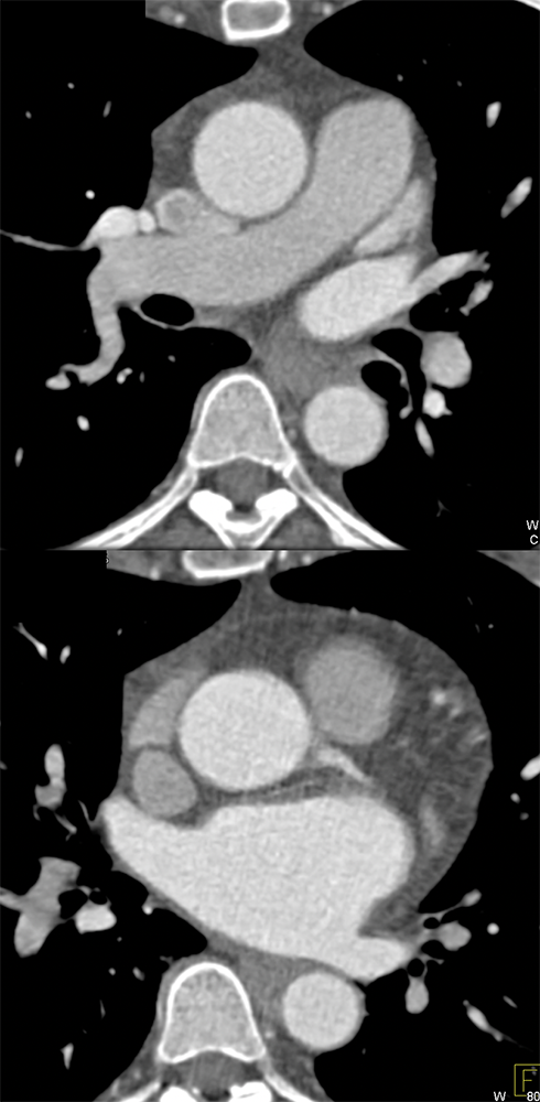 CCTA:Pseudolesion Aortic Root