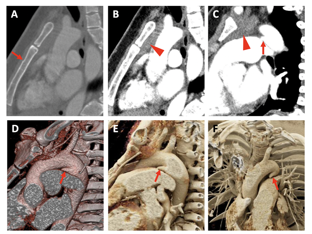 Trauma to the Thoracic Aorta