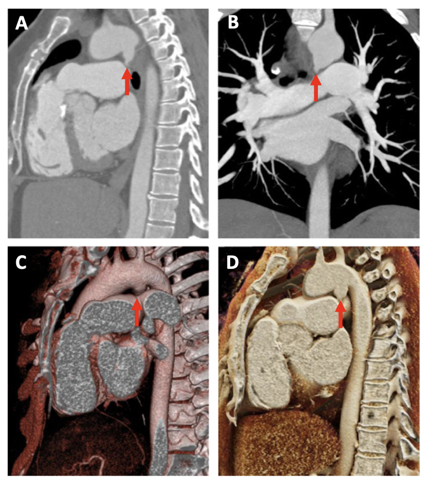 Trauma to the Thoracic Aorta