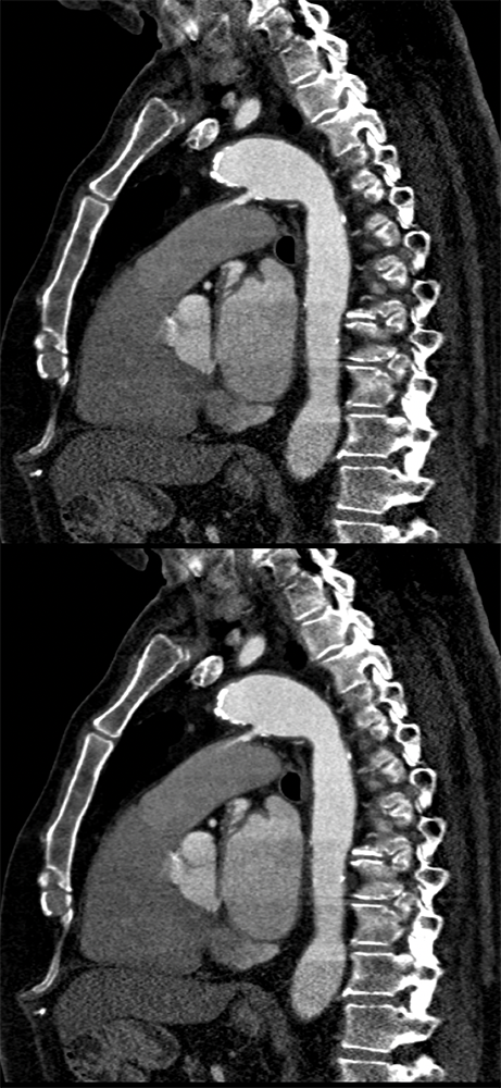MVA with PDA