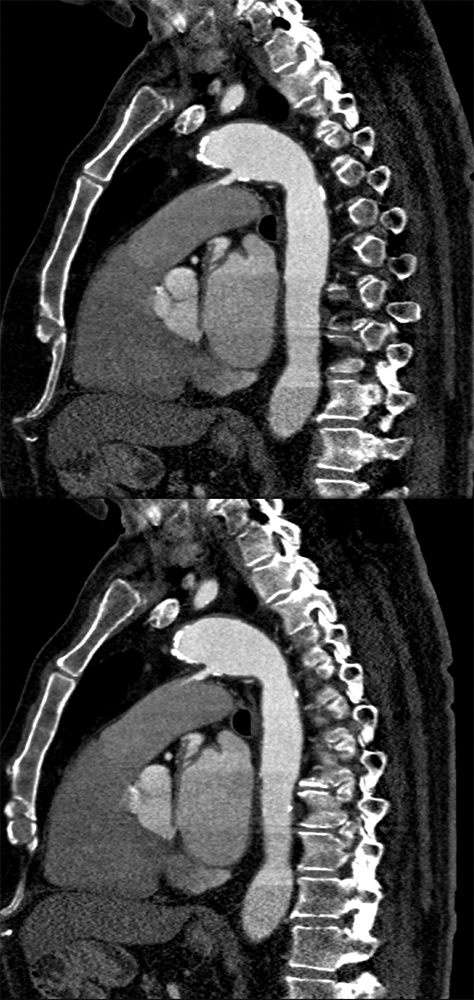 Trauma to the Thoracic Aorta