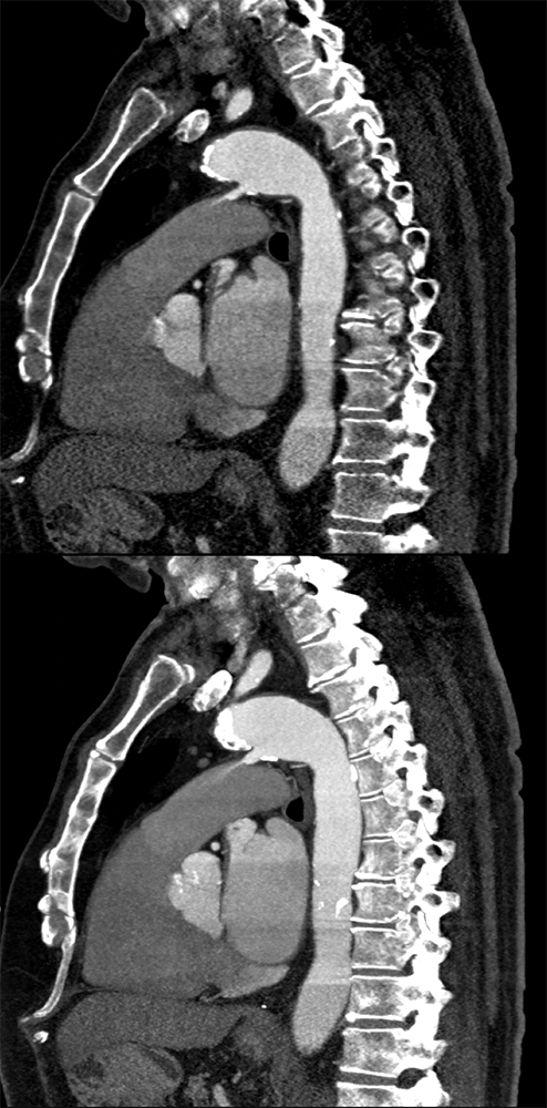 Trauma to the Thoracic Aorta