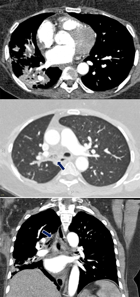 Aspiration Pneumonia
