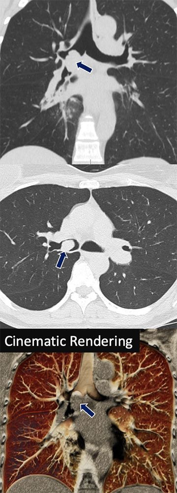 Mucoepidermoid Carcinoma