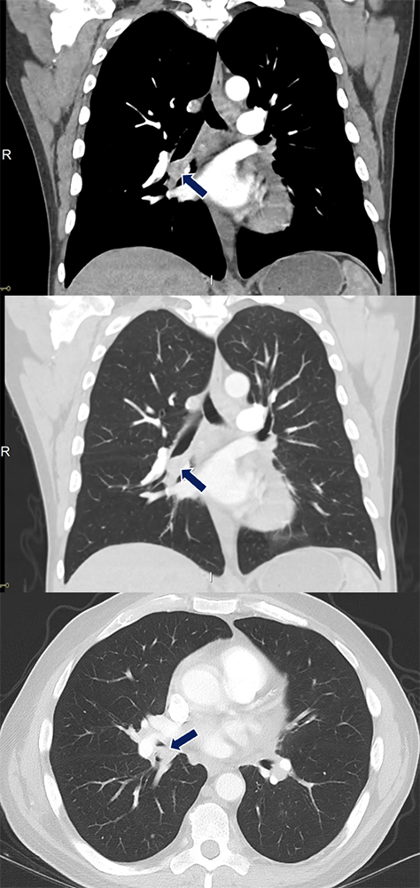 Metastasis from Renal Cell Carcinoma