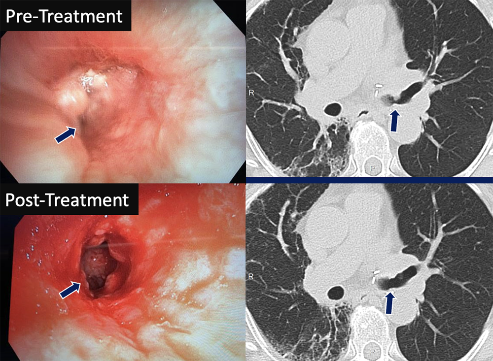 Bronchial Stenosis
