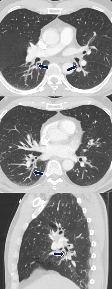 Bronchial Asthma