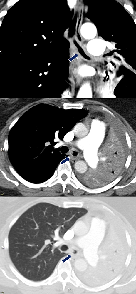 Tracheobronchial Amyloidosis