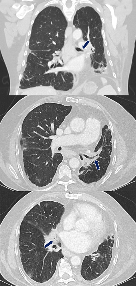 Sarcoidosis