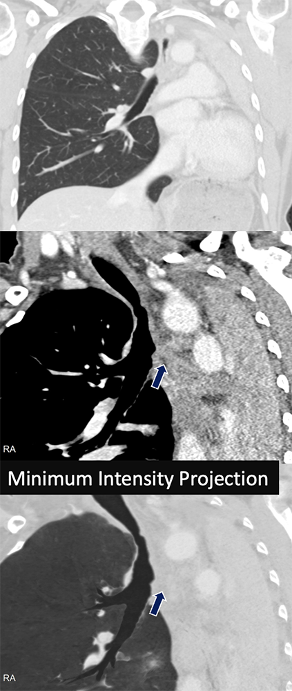 Tuberculosis