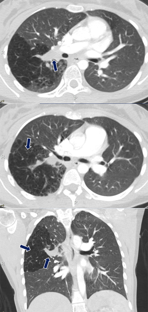 Bronchial Atresia