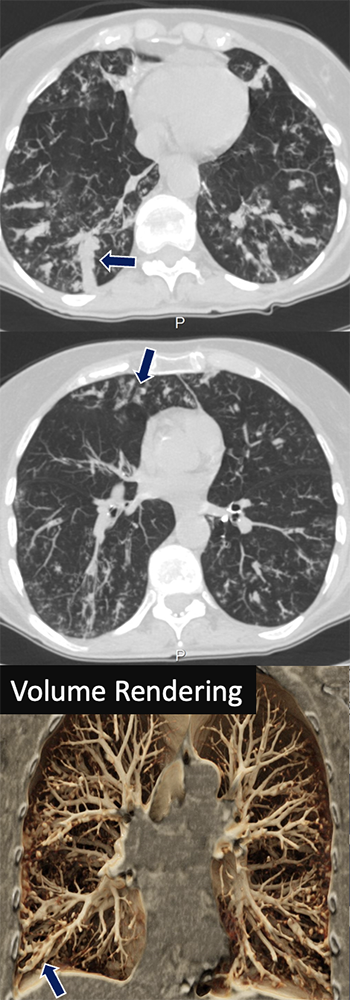 Nontuberculous Mycobacterial Infection