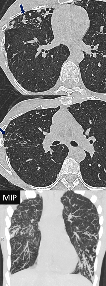 Pseudomonas Infection