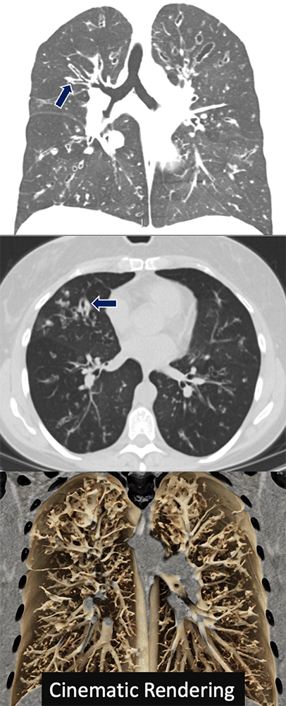 Cystic Fibrosis