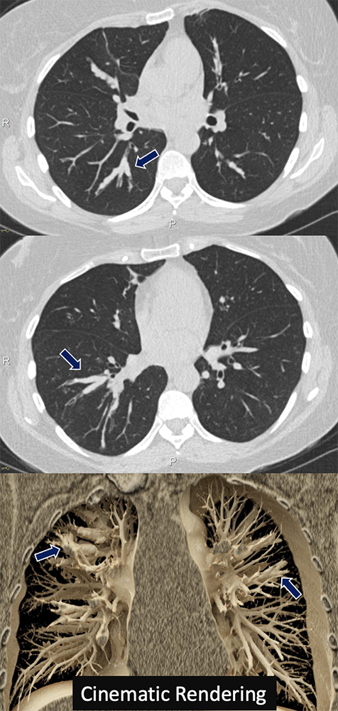 Allergic Bronchopulmonary Aspergillosis