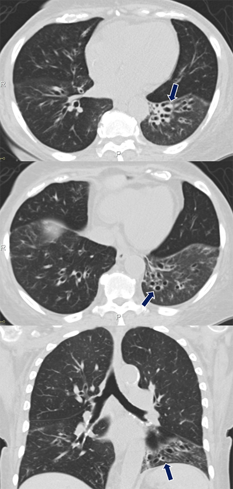 Graft Versus Host Disease