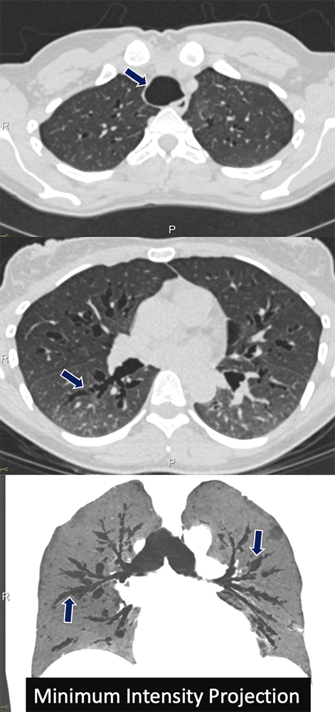 Tracheobronchomegaly