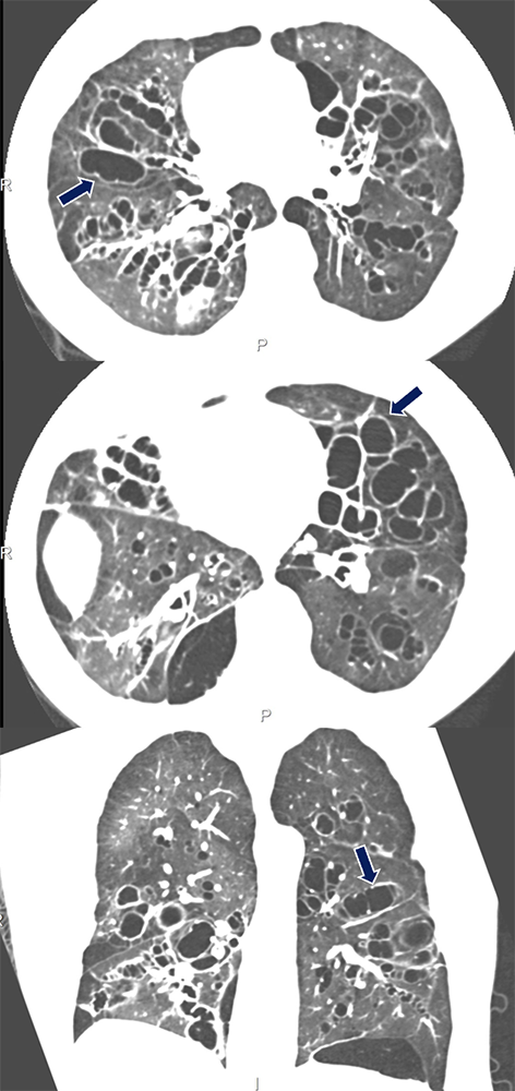 Williams-Campbell Syndrome