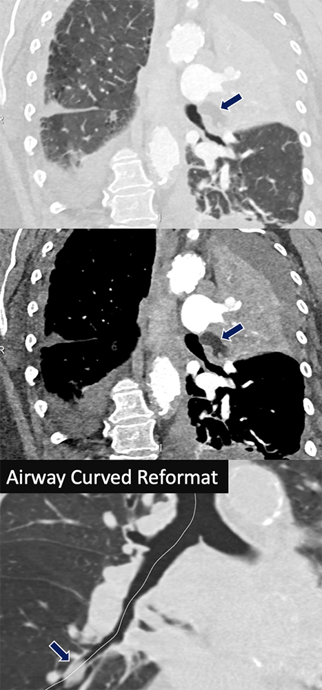 Pulmonary Hamartoma