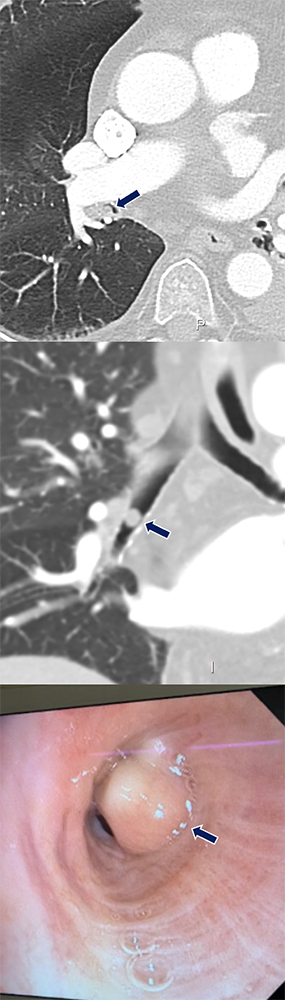 Pulmonary Hamartoma