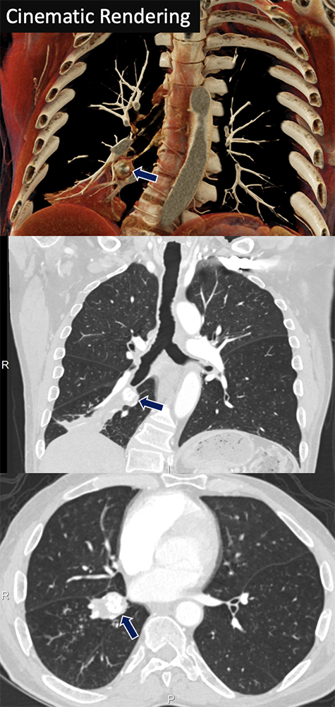 Carcinoid