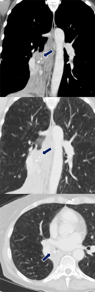 Adenoid Cystic Carcinoma