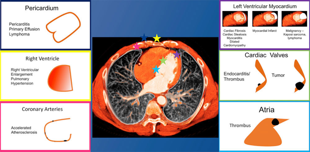 Cardiac Involvement in HIV