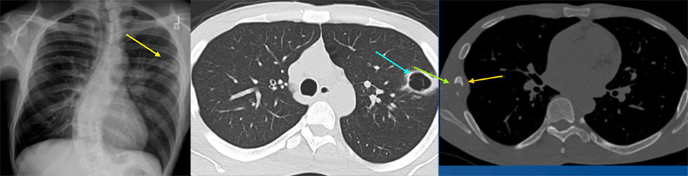36 year old man with well controlled HIV with right sided chest pain, left leg pain, weight loss and night sweats