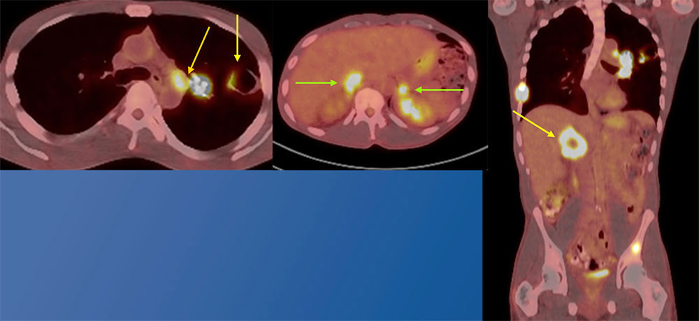 Follow up PET/CT six days later