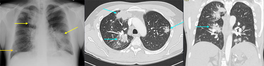 36 year old male with recently diagnosed HIV not on HAART