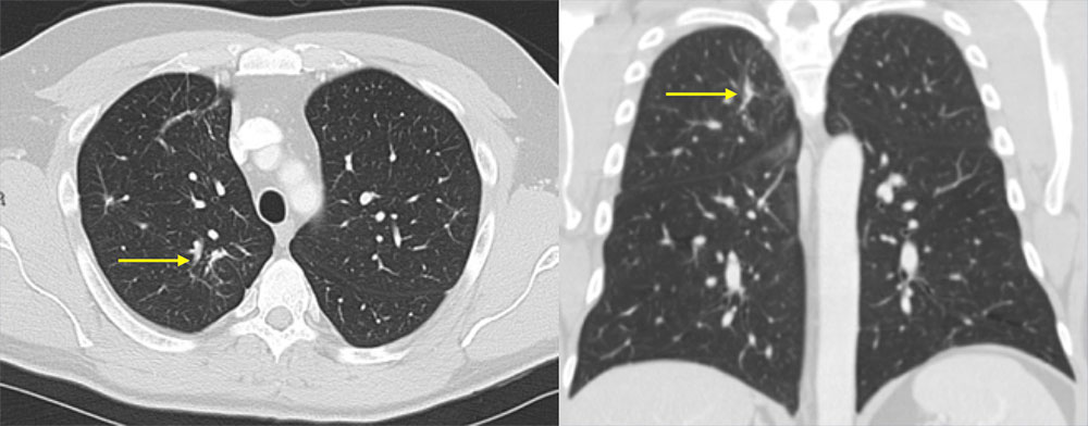 36 year old male with recently diagnosed HIV not on HAART