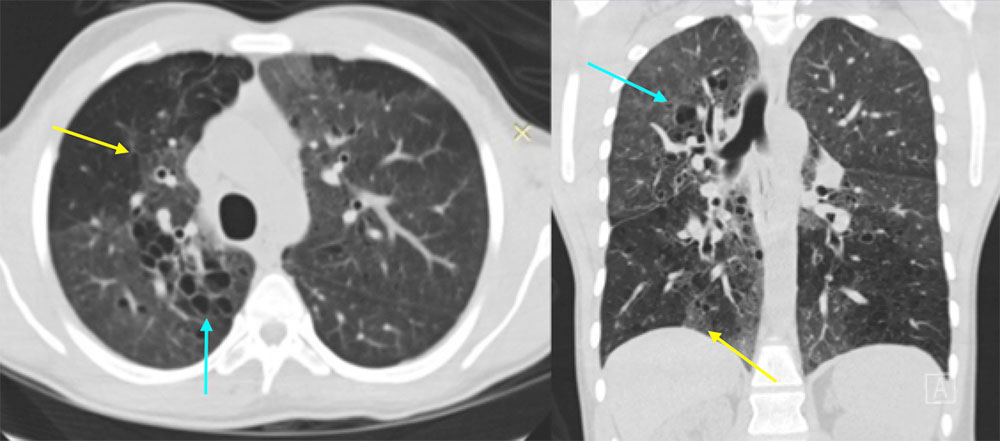28 year old male with congenital HIV, dyspnea, and chest pain 