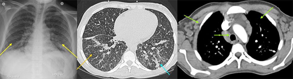 27 year old female with history of HIV not on treatment, admitted for retinal necrosis from VZV infection