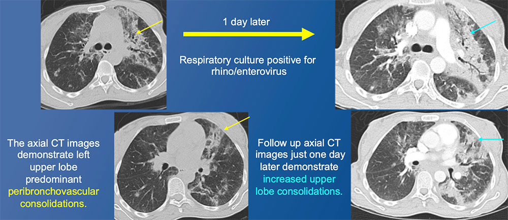 34 year old female recently started on HAART for new diagnosis of HIV 