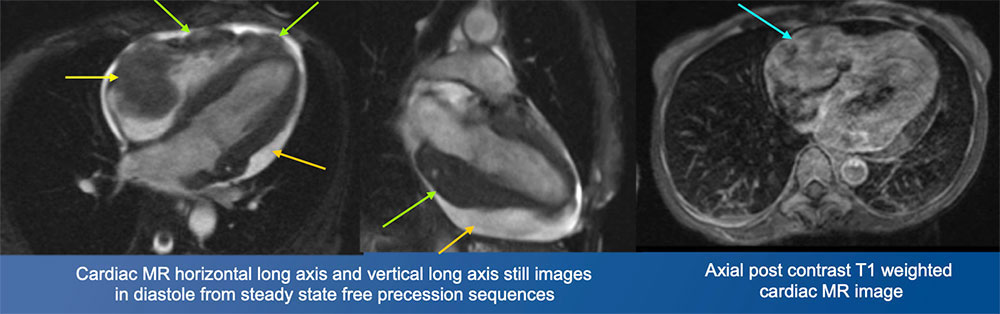 Burkitt Lymphoma