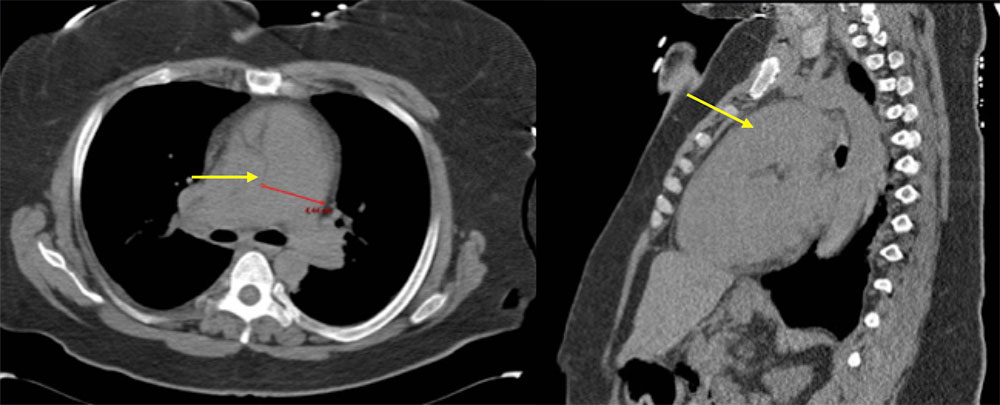 39 year old woman with HIV with cough