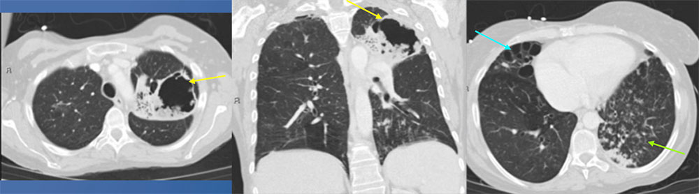 41 year old female with history of HIV, HCV, tricuspid endocarditis, pulmonary hypertension, MAI lung infection on treatment