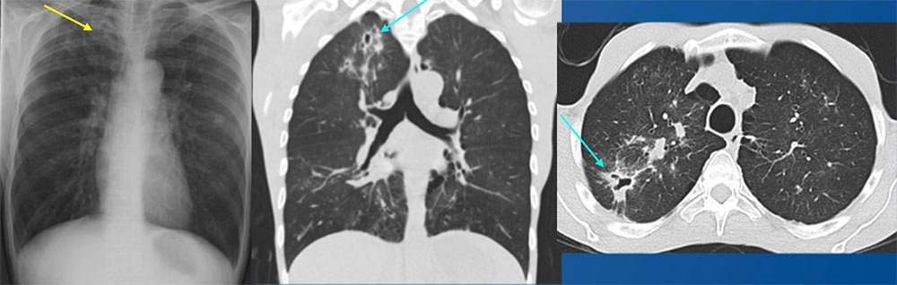 49 year old male with HIV